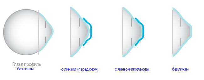 Профиль роговицы без линзы, с линзой перед сном и после сна